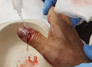 Cura suero dedo pulgar